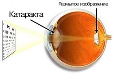 катаракта операция катаракта операция