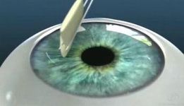 проведём операцию Ласик в Москве