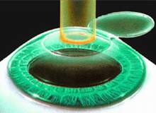 ласик операция цена