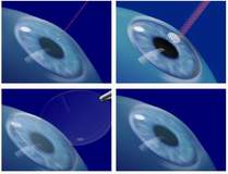 Ласик — операция по ценам клиники доктора Коновалова