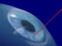 операция Ласик – осложнения немногочисленны