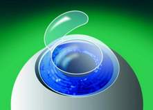 ласик отзывы