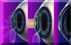 Ласик – последствия минимальны