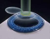 лазерная коррекция стоимость