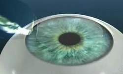 лазерная операция Ласик очень эффективна