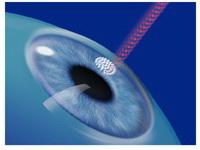 лазик после операции