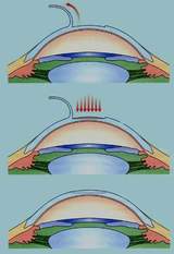 узнайте на операцию Лазик стоимость на&nbsp;нашем сайте