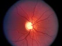 лечение глаукомы лазером в&nbsp;клинике Коновалова