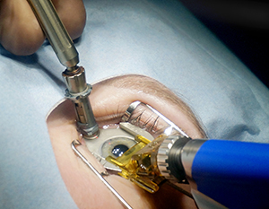 с помощью микрокератома, формируется тонкая пластинка роговицы