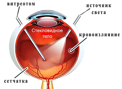 Картинки по запросу "субтотальная витрэктомия"