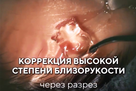 Коррекция высокой степени близорукости
