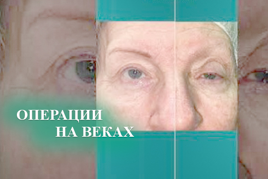 Пластические операции на веках