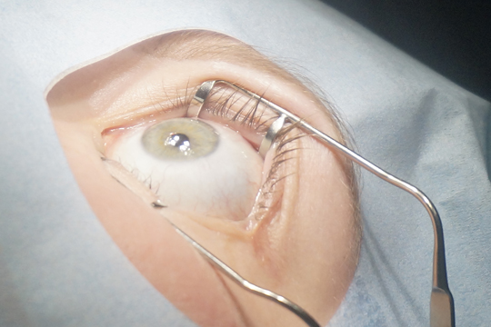 Стоимость операции ЛАСИК. Основные компоненты