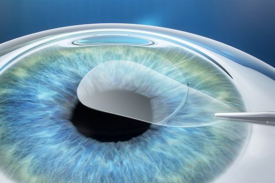 Лазерная коррекция зрения SMILE