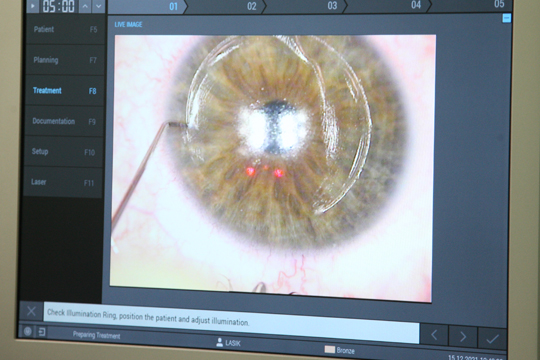 Возможности операции Лазик в восстановлении зрения