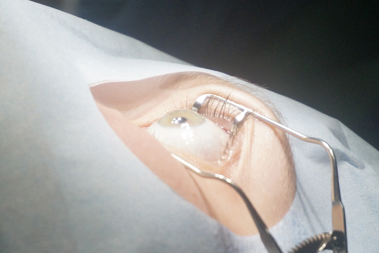 Все о методе Супер Лазик