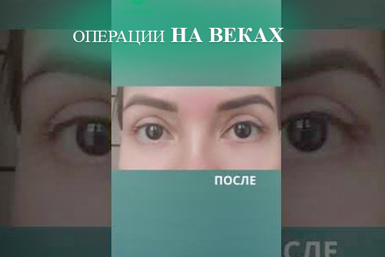 Операции на веках