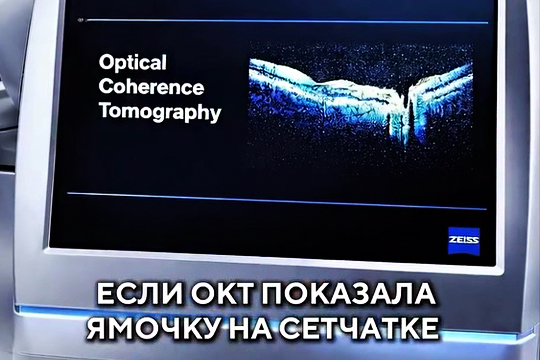 Почему на снимке ОКТ в центре ямочка