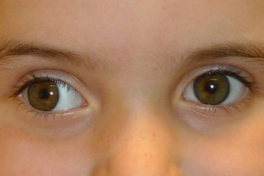 Детское косоглазие – операция или консервативное лечение?