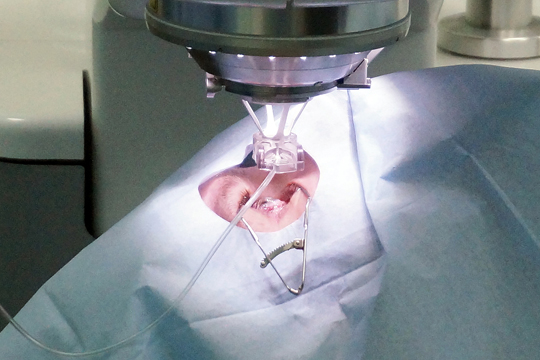 Коррекция зрения лазером - надежный метод восстановления зрения