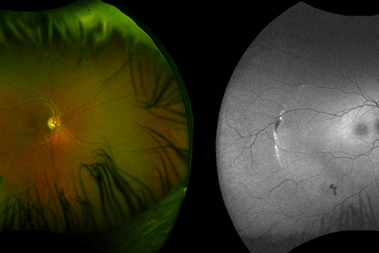 Ретиношизис