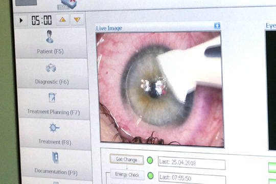 Лазик - после операции отличное зрение