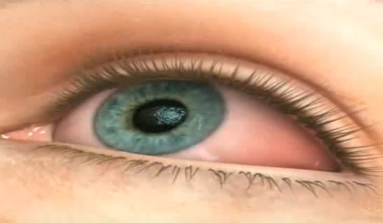 Синдром сухого глаза (3D)