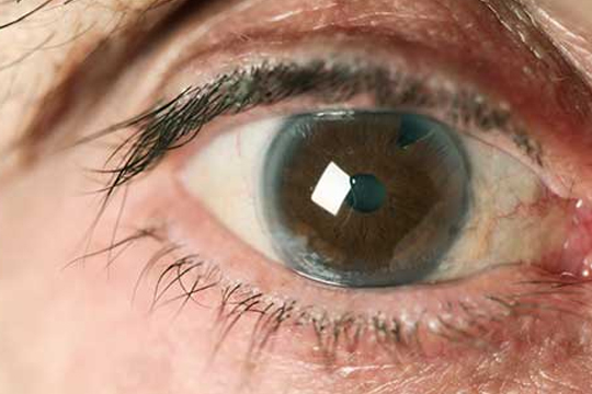 Вторичная катаракта: признаки и лечение