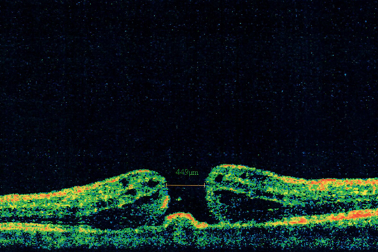 Макулярный разрыв