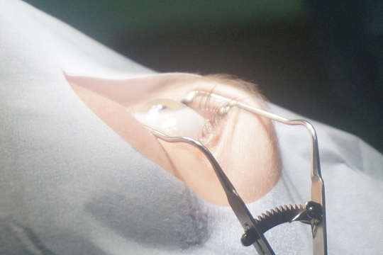 Супер Ласик – прорыв в лазерной коррекции зрения