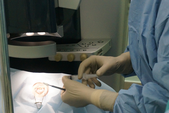 История лазерной коррекции зрения