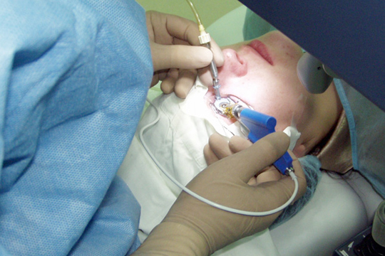 Виды эксимер лазерной коррекции зрения