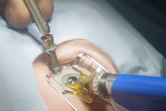 Современный способ коррекции близорукости