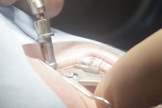 ФРК или ЛАСИК. Что выбрать?