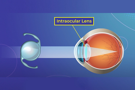 Операция по установке ИОЛ