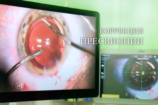 Рефракционная замена хрусталика, коррекция пресбиопии