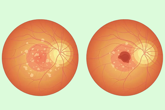 Дегенерация макулы