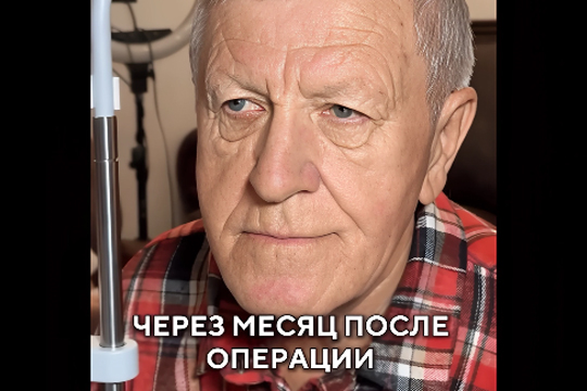 Результат через месяц после операции по исправлению косоглазия