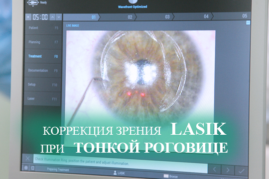 Коррекция зрения ласик при тонкой роговице