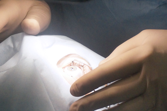 Операция супер ЛАСИК