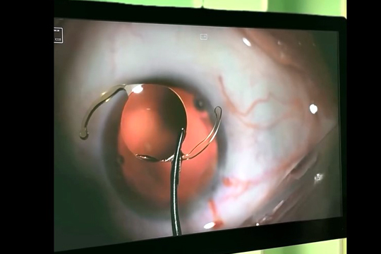 Монофокальная ИОЛ с углубленным фокусом
