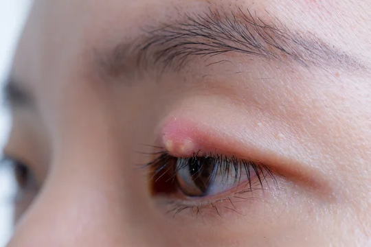 Халазион верхнего и нижнего века