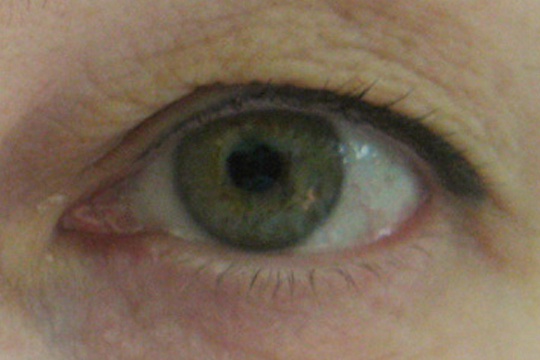 Блефароптоз и методы его устранения