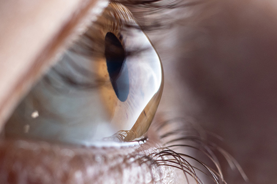 Современное лечение кератоконуса