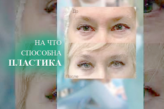 На что способна пластика век
