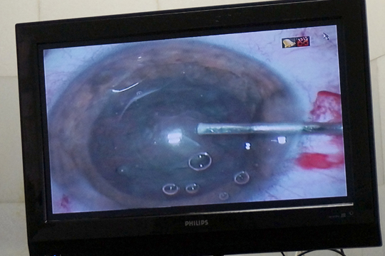 Замена хрусталика при катаракте