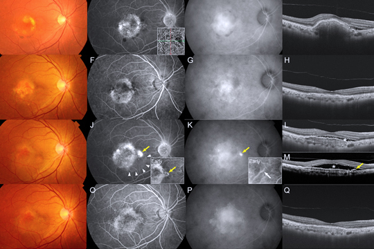 Центральная серозная хориоретинопатия
