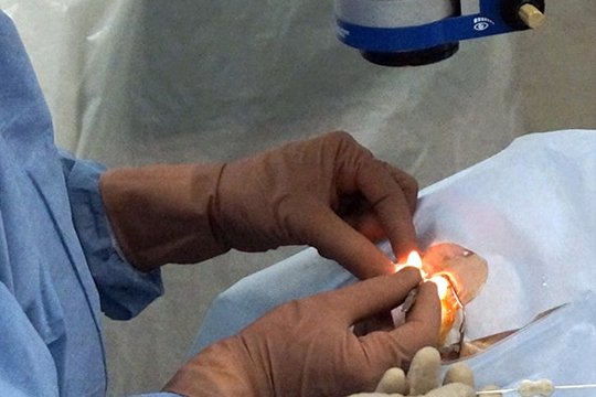 Ограничения после операции по удалению катаракты и замены хрусталика