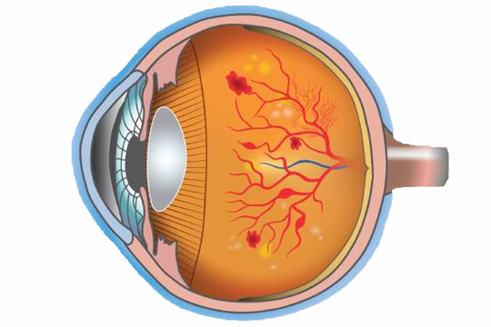 Диабетическая ретинопатия: стадии, симптомы и лечение
