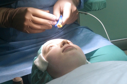 Основные преимущества операции lasik